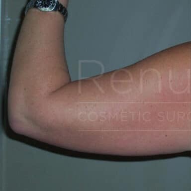 Procedure before and after - before