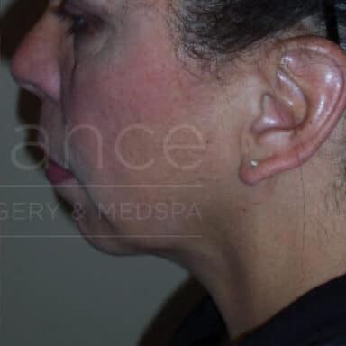 Procedure before and after - after