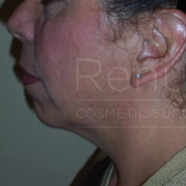 Procedure before and after - before