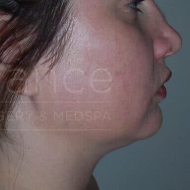 Procedure before and after - after