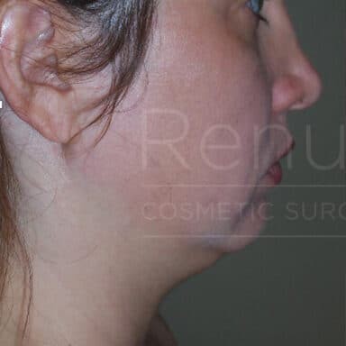 Procedure before and after - before