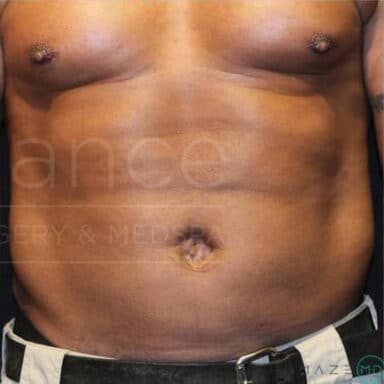 Procedure before and after - after