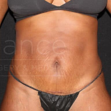 Procedure before and after - after