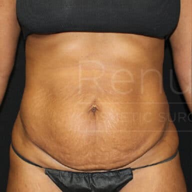 Procedure before and after - before