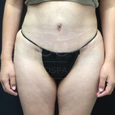 Procedure before and after - after