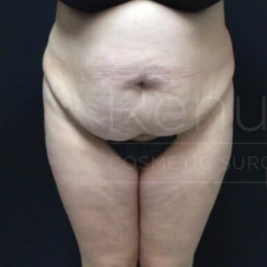 Procedure before and after - before