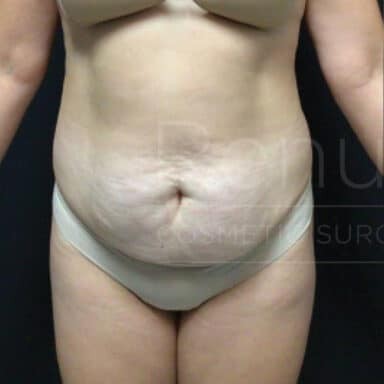 Procedure before and after - before