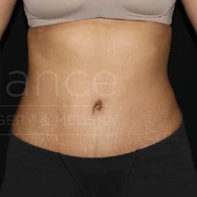 Procedure before and after - after