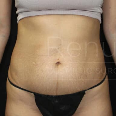 Procedure before and after - before