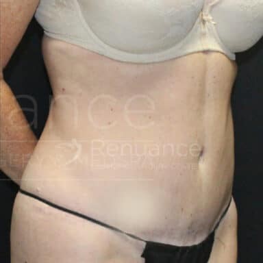 Procedure before and after - after