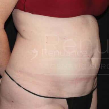 Procedure before and after - before