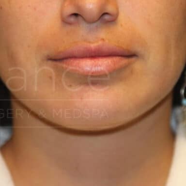 Procedure before and after - after