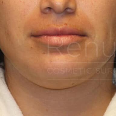 Procedure before and after - before