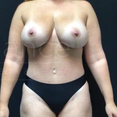 Procedure before and after - after