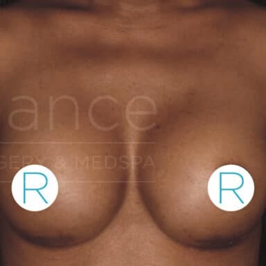 Procedure before and after - after
