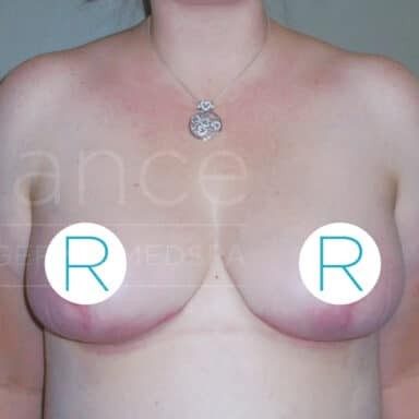 Procedure before and after - after