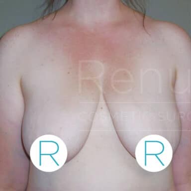 Procedure before and after - before