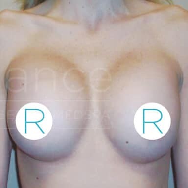 Procedure before and after - after