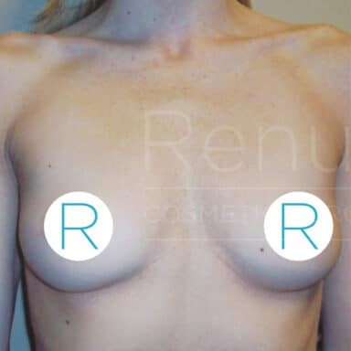 Procedure before and after - before