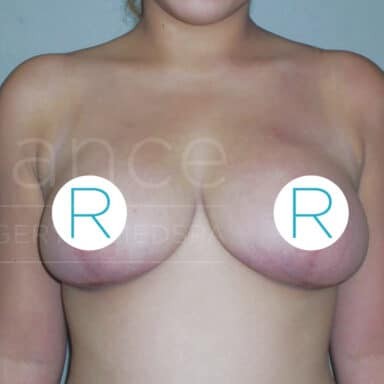 Procedure before and after - after