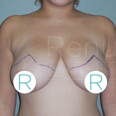 Procedure before and after - before