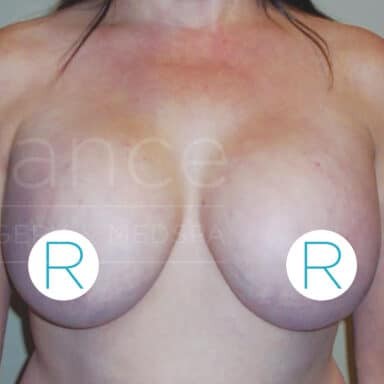 Procedure before and after - after