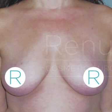 Procedure before and after - before