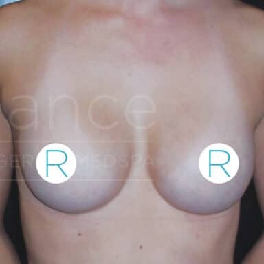 Procedure before and after - after