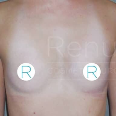 Procedure before and after - before