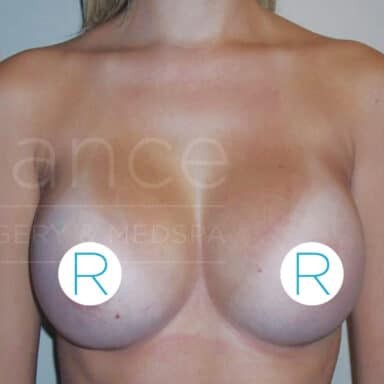 Procedure before and after - after