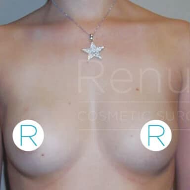 Procedure before and after - before