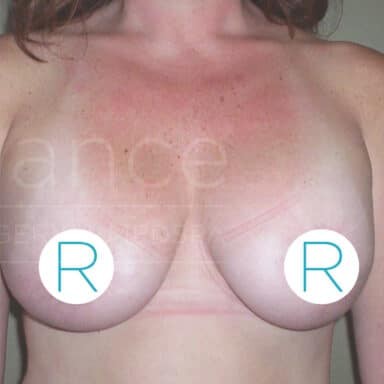 Procedure before and after - after