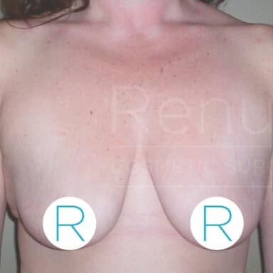 Procedure before and after - before