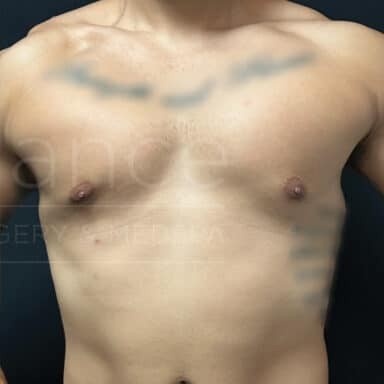 Procedure before and after - after