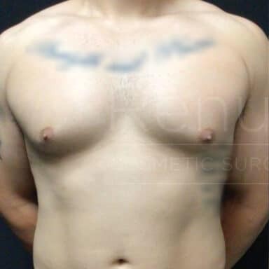 Procedure before and after - before