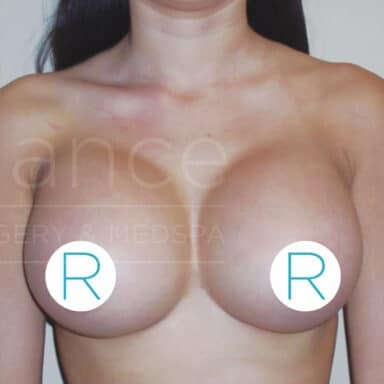 Procedure before and after - after