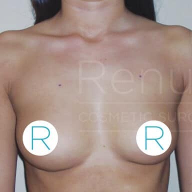 Procedure before and after - before