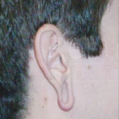 Procedure before and after - before