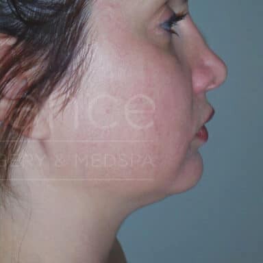 Procedure before and after - after
