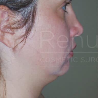 Procedure before and after - before