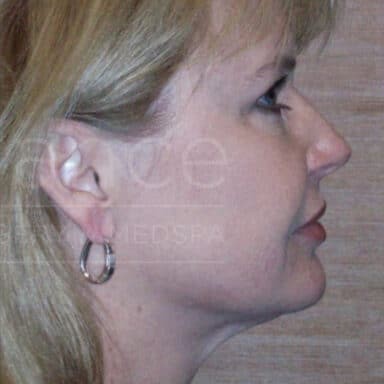Procedure before and after - after