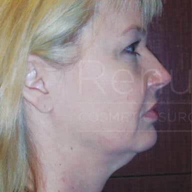 Procedure before and after - before