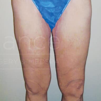 Procedure before and after - after