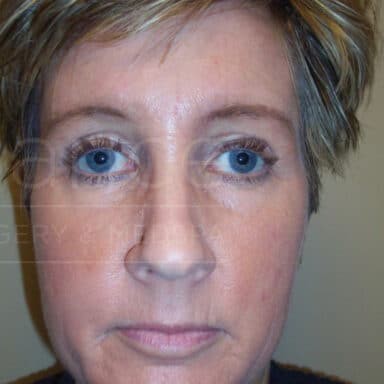 Procedure before and after - after