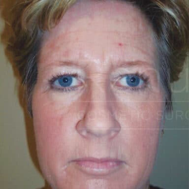 Procedure before and after - before