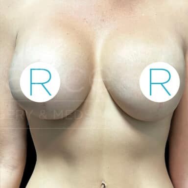 Procedure before and after - after