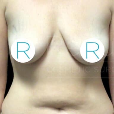 Procedure before and after - before