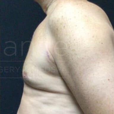 Procedure before and after - after