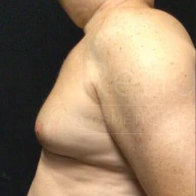 Procedure before and after - before