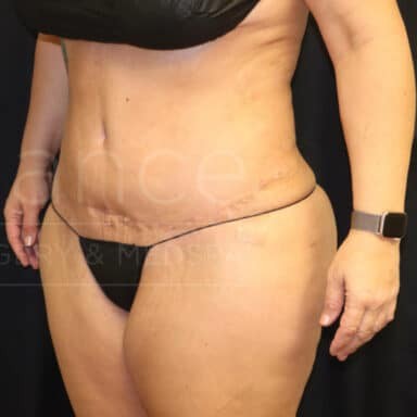 Procedure before and after - after